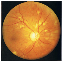 糖尿病網膜症 | 木更津 眼科／ほたるの眼科